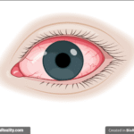 Conjunctivitis - Cause, Diagnosis, and Treatment