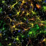 alzheimer's brain