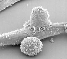 t cell lymphoma representation